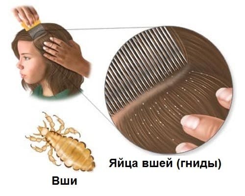 На фото показано, как вычесать вшей